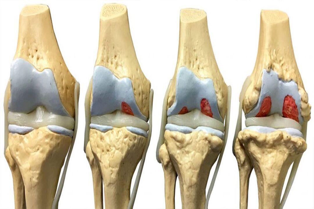 Estágios do desenvolvimento da osteoartrite