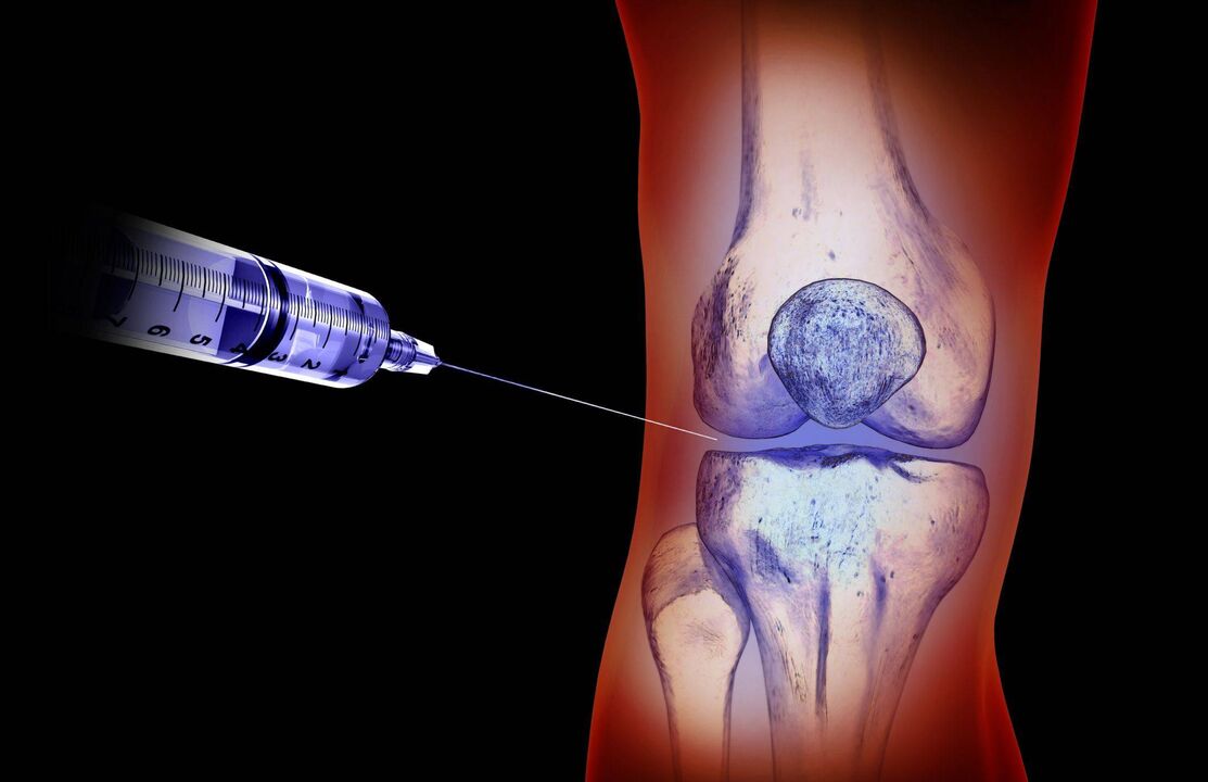 injeções intra-articulares para osteoartrite