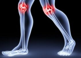 As razões para o desenvolvimento da osteoartrite do joelho