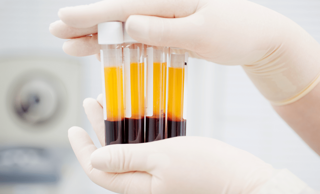 Plasma rico em plaquetas para terapia com PRP para osteoartrite